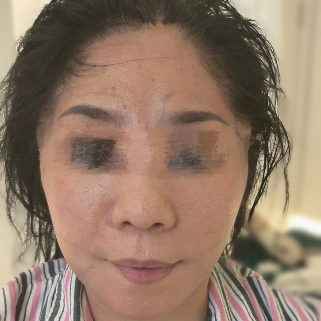 她说：过去我曾尝试过拉皮手术，但结果却留下了难以磨灭痕迹！