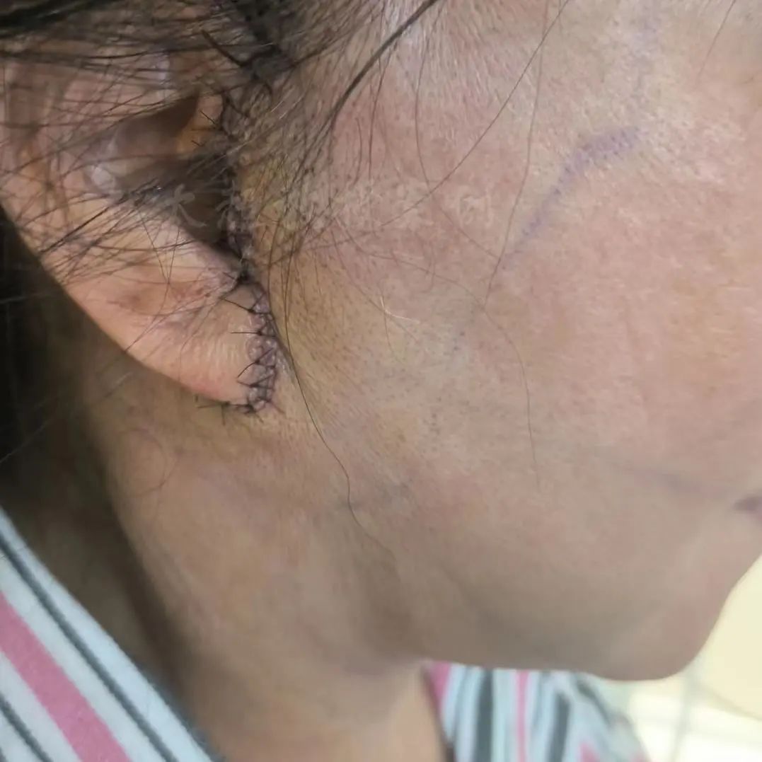 她说：过去我曾尝试过拉皮手术，但结果却留下了难以磨灭痕迹！