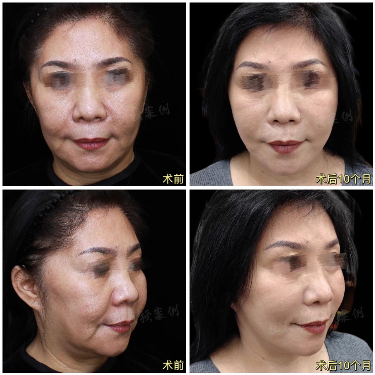 她说：过去我曾尝试过拉皮手术，但结果却留下了难以磨灭痕迹！