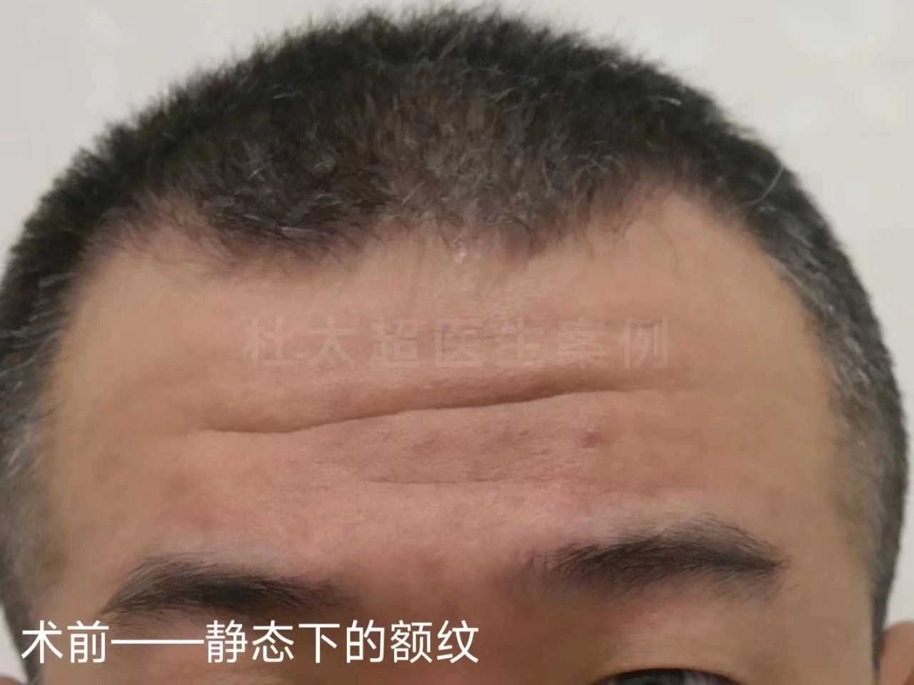 45岁男士额纹深邃，不接受大切口除皱，这样做有效改善！