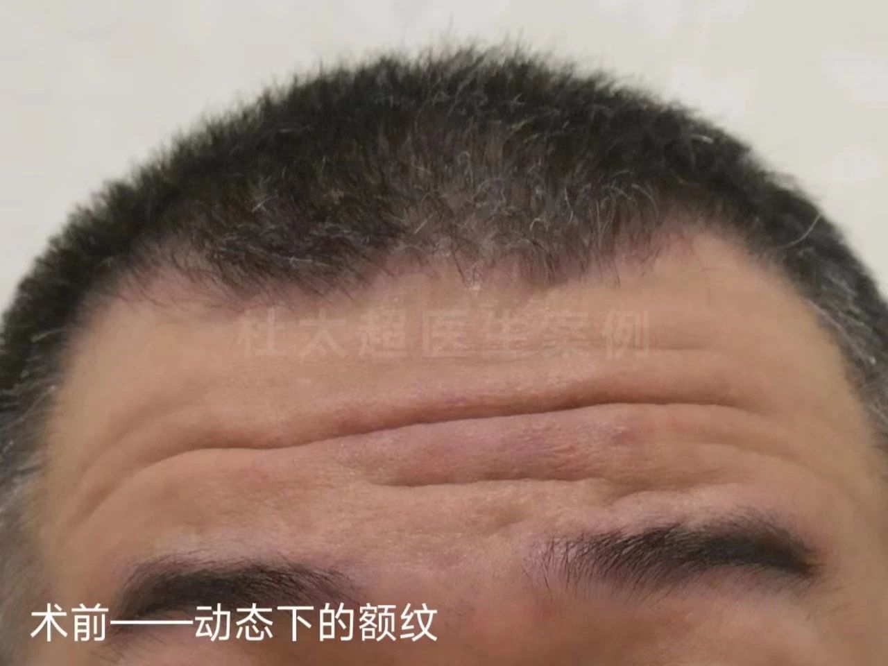 45岁男士额纹深邃，不接受大切口除皱，这样做有效改善！