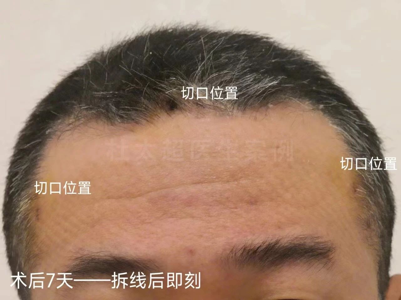 45岁男士额纹深邃，不接受大切口除皱，这样做有效改善！