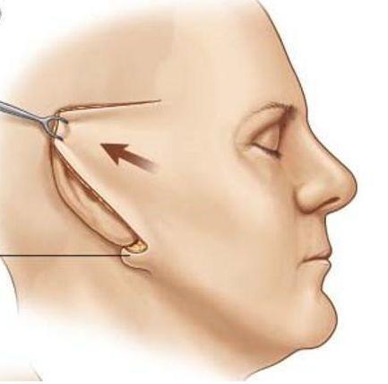 一次拉皮能维持10年？为什么我做的半年就垮了！