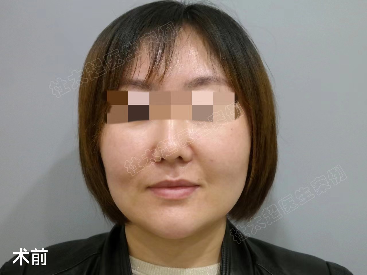 36岁接受不了血淋淋的大拉皮，选择小拉皮提升，记录手术全过程