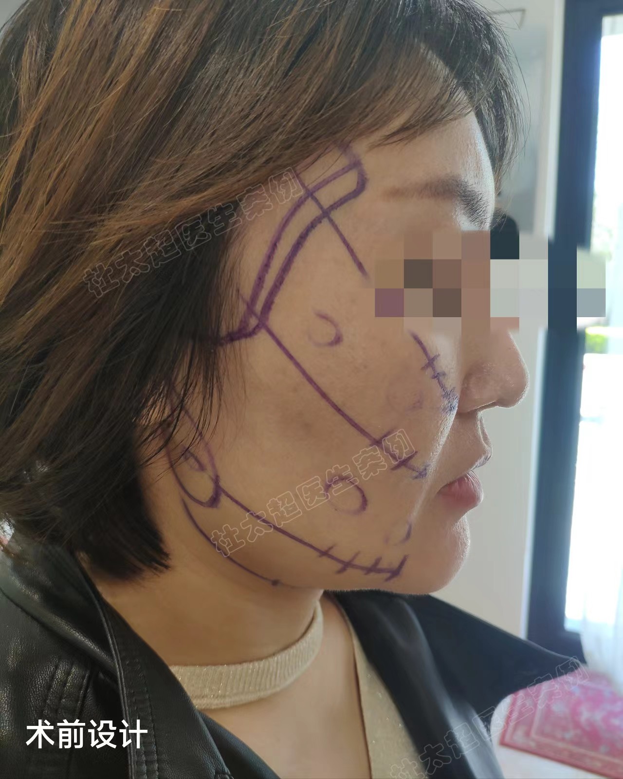 36岁接受不了血淋淋的大拉皮，选择小拉皮提升，记录手术全过程