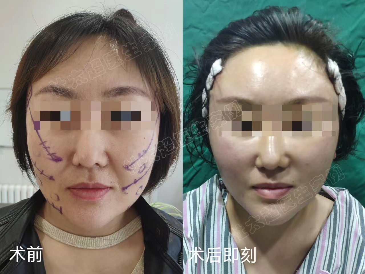 36岁接受不了血淋淋的大拉皮，选择小拉皮提升，记录手术全过程