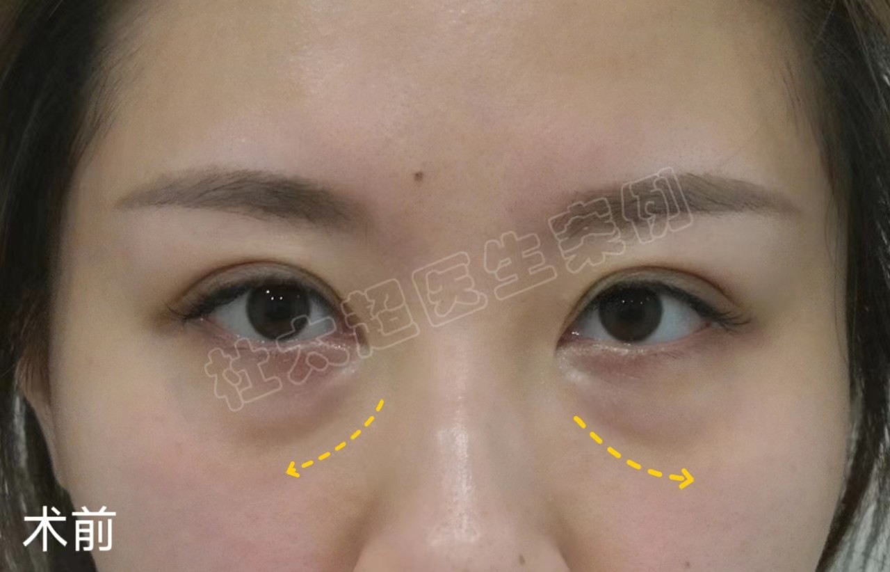 我做了微创去眼袋，只用了7天恢复，眼周重现年轻态