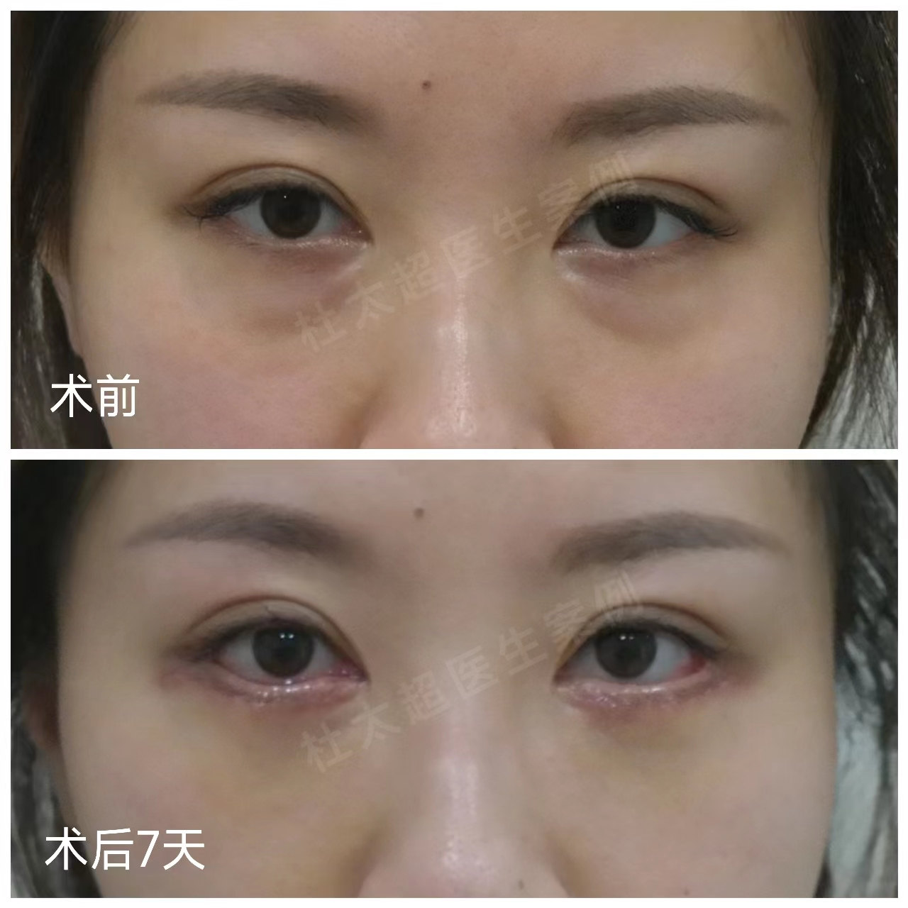 我做了微创去眼袋，只用了7天恢复，眼周重现年轻态
