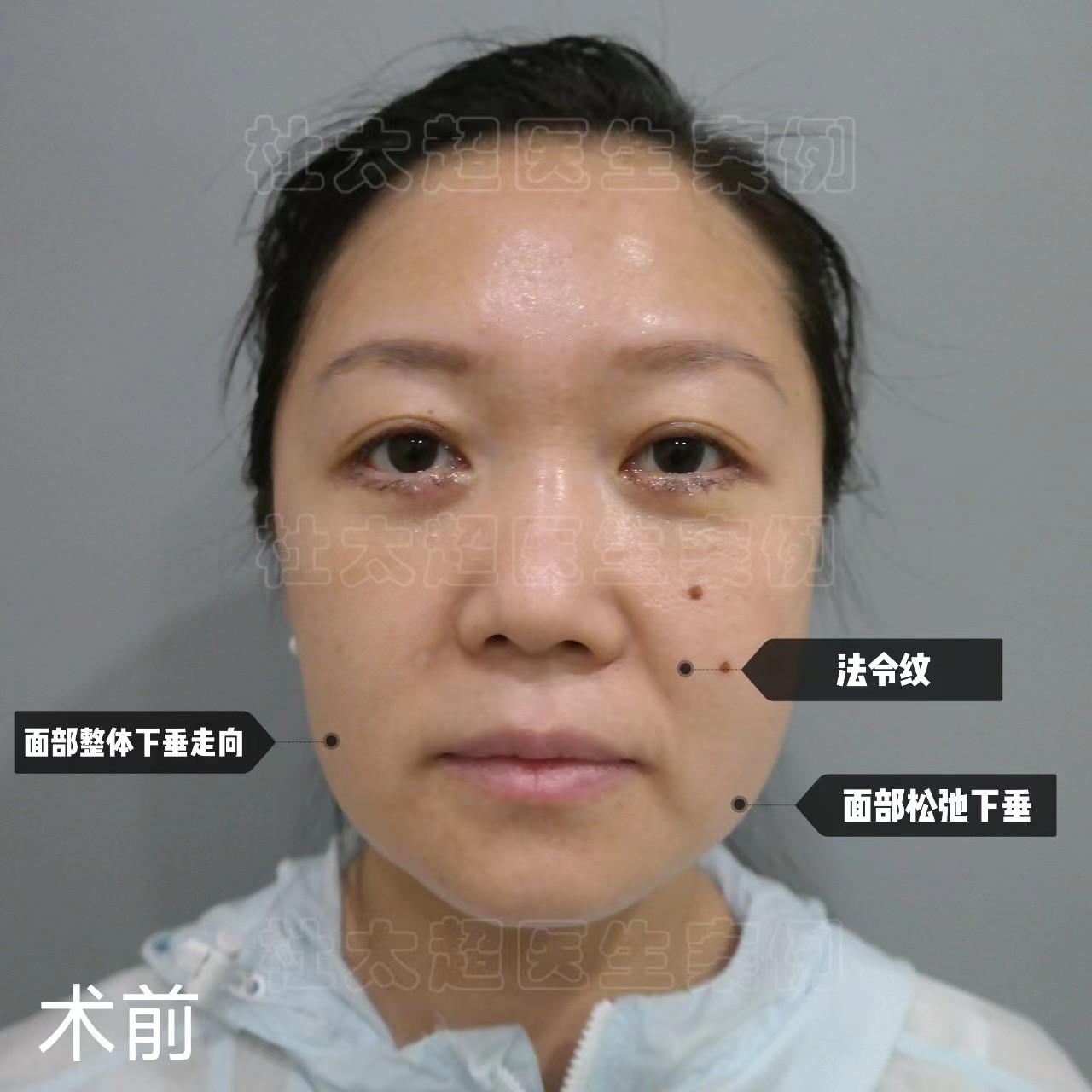 真人案例，36岁先后做了眼袋和拉皮手术，听她聊一聊自己的感受