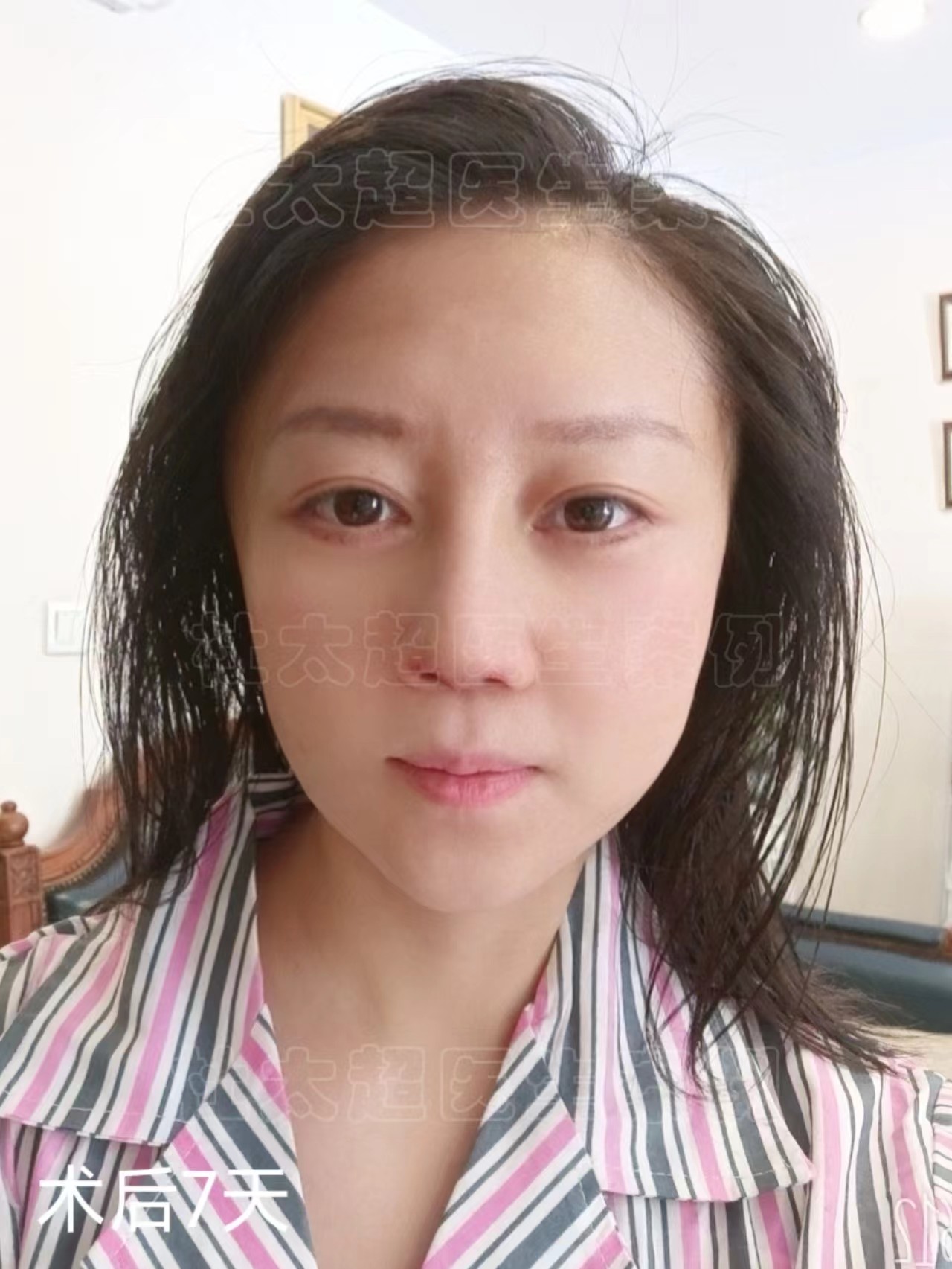 真人案例，36岁先后做了眼袋和拉皮手术，听她聊一聊自己的感受