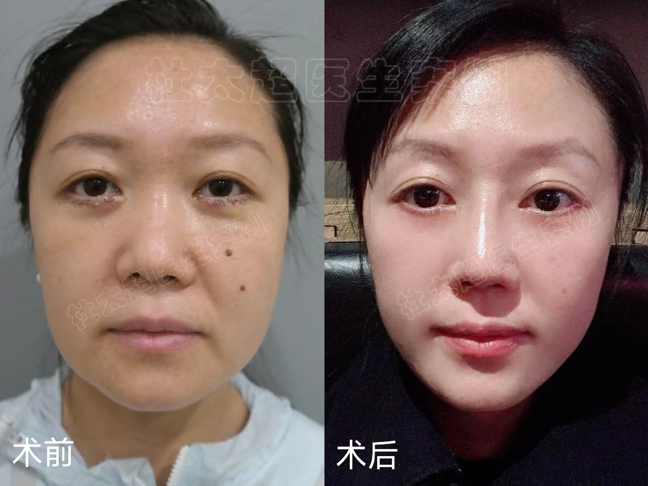 真人案例，36岁先后做了眼袋和拉皮手术，听她聊一聊自己的感受