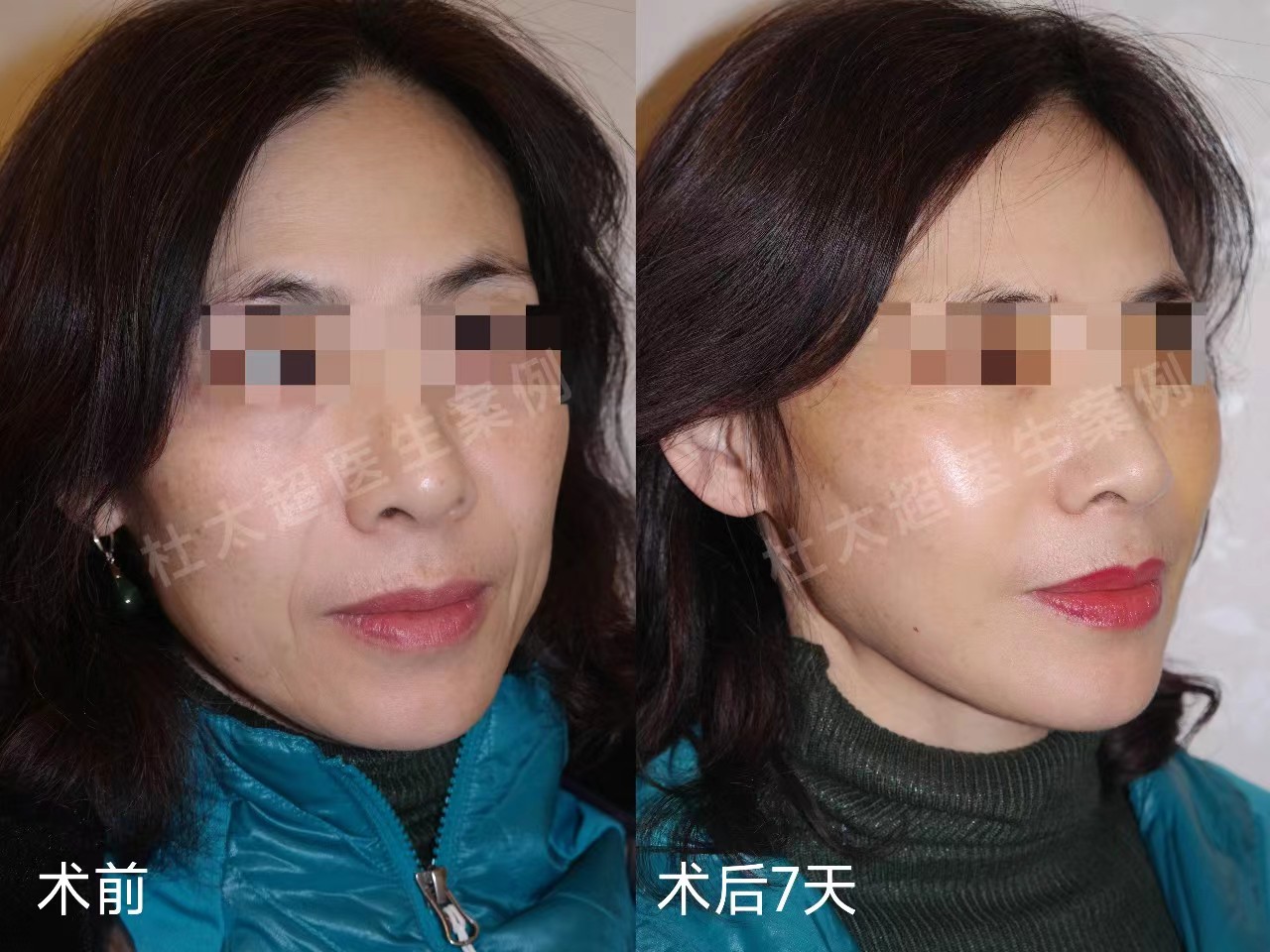 赶在女儿婚礼前做了拉皮手术，看看我术后7天的变化