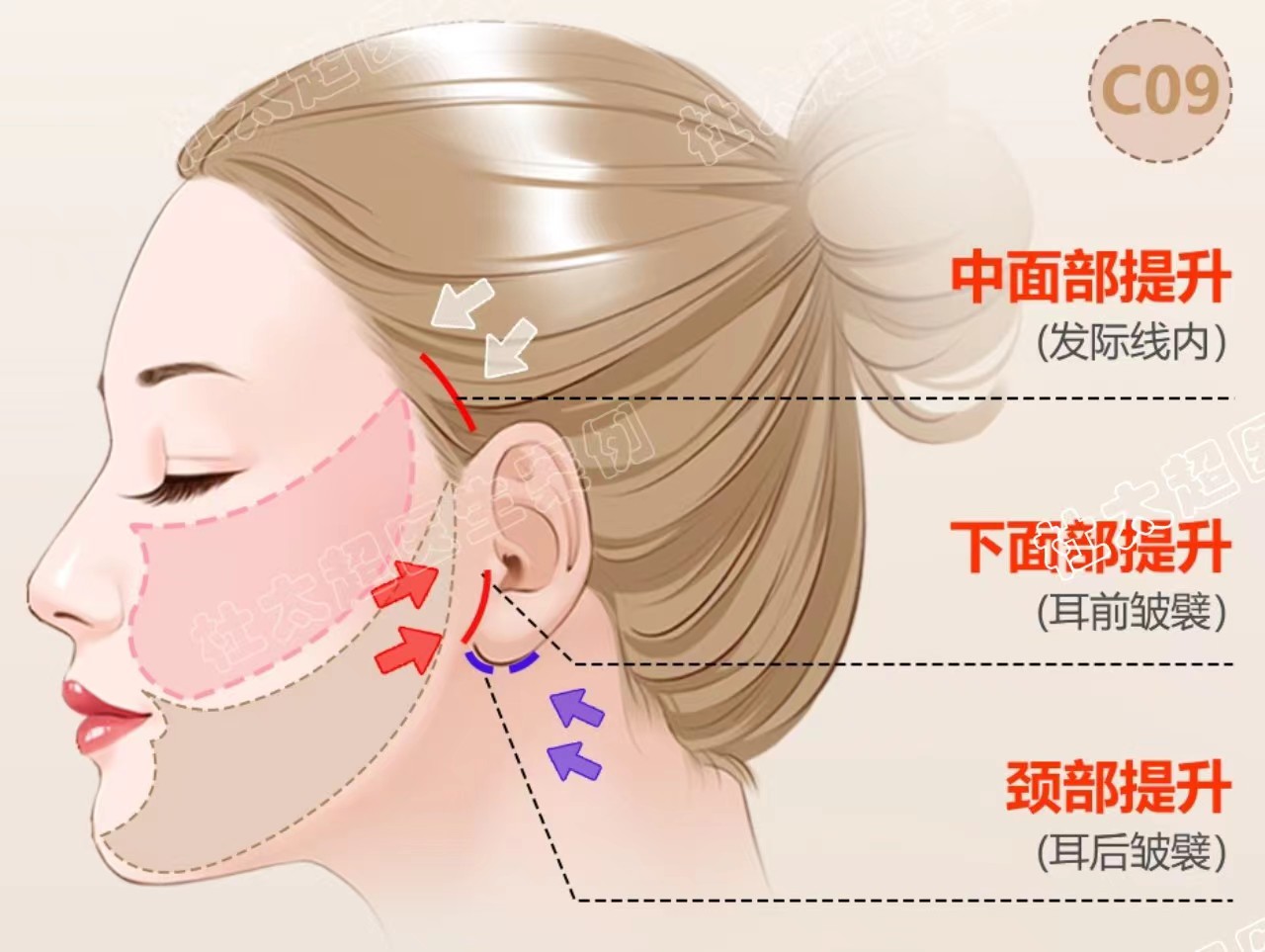 赶在女儿婚礼前做了拉皮手术，看看我术后7天的变化