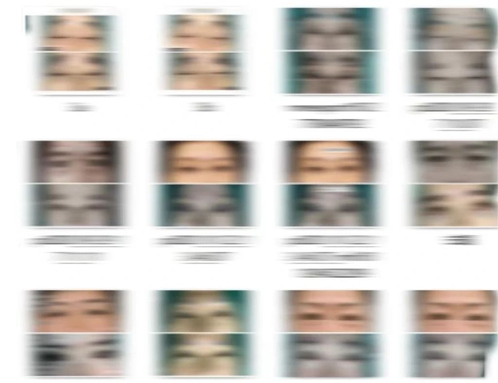 我做了微创去眼袋，只用了7天恢复，眼周重现年轻态！