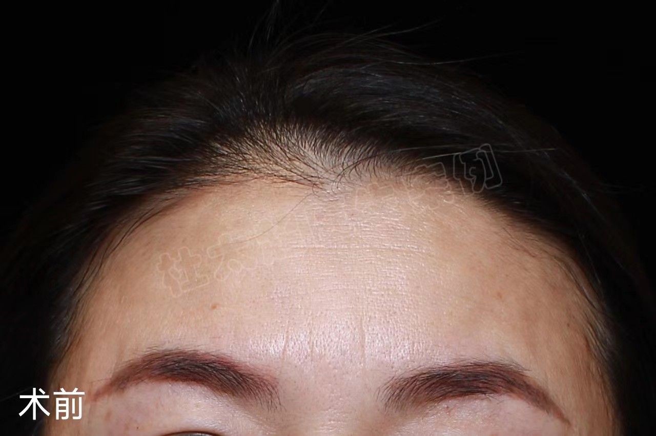 49岁女士做额部除皱，分享让“山川”变“平原”的秘密！