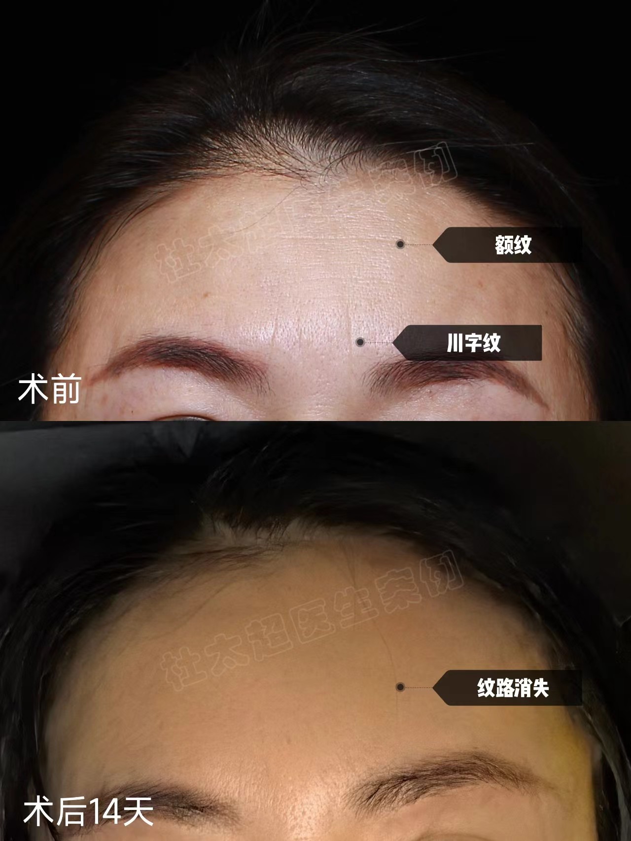 49岁女士做额部除皱，分享让“山川”变“平原”的秘密！