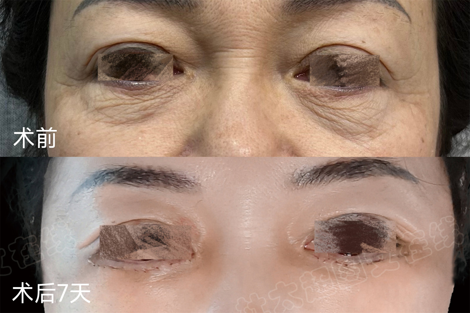 54岁求美者，为了变美奔赴北京做了拉皮提升，自己都被惊艳到