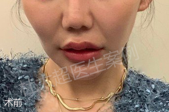 27岁女孩的微整日记，小拉皮提升挽救了我