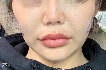 27岁女孩的微整日记，小拉皮提升挽救了我