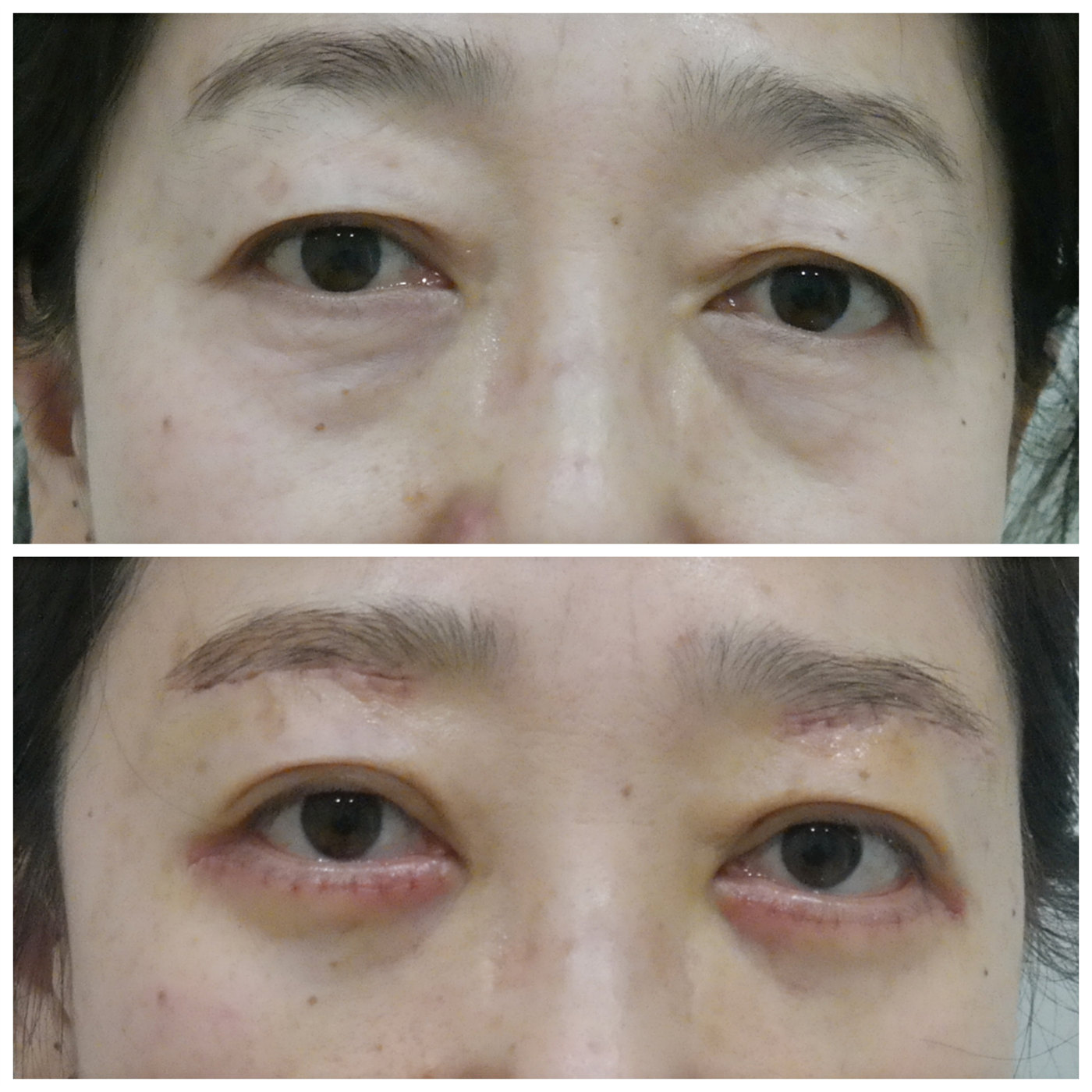 眼袋手术7天能恢复成什么样？