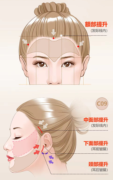 做完拉皮手术后需要坐飞机,可以正常出行吗? 做完拉皮手术后需要坐飞机,可以正常出行吗?