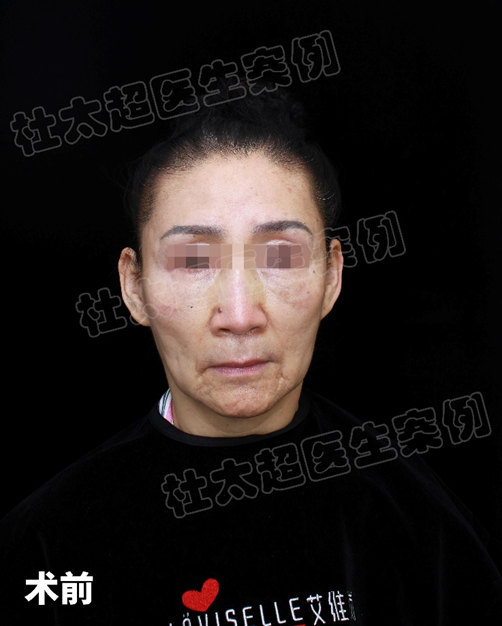 爱美不分年龄，69岁阿姨挑战拉皮