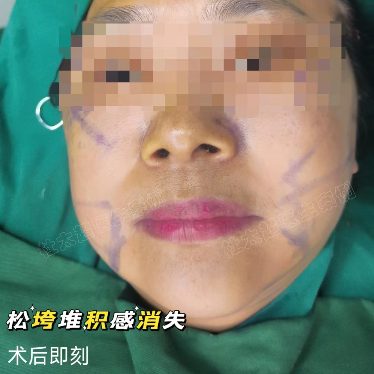 好直接！拉皮之后，松垂皱纹没有了，年轻真好！