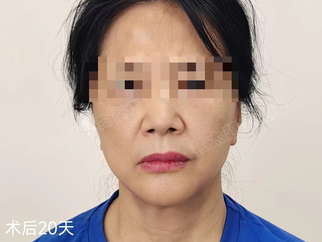 好直接！拉皮之后，松垂皱纹没有了，年轻真好！