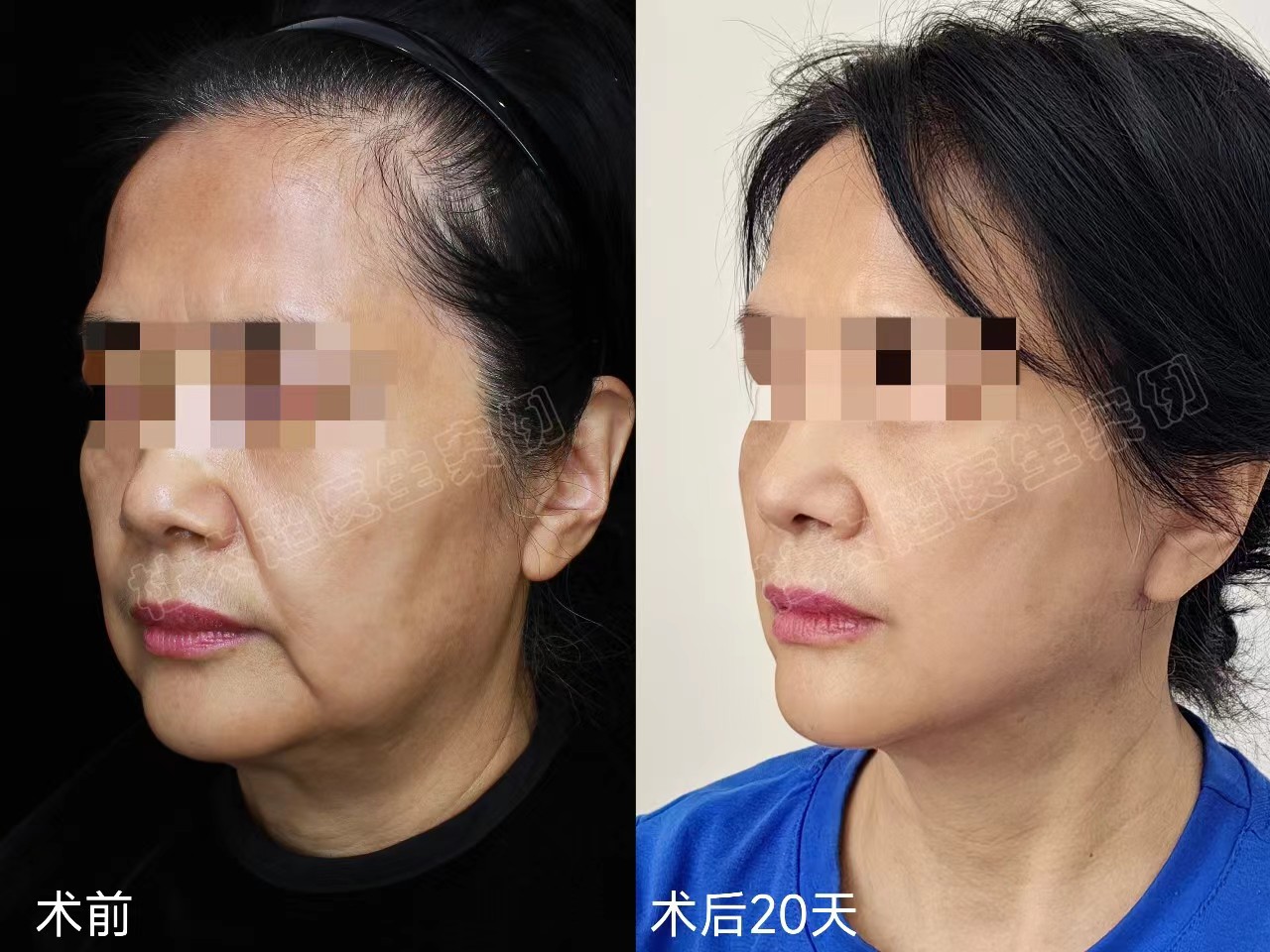 好直接！拉皮之后，松垂皱纹没有了，年轻真好！