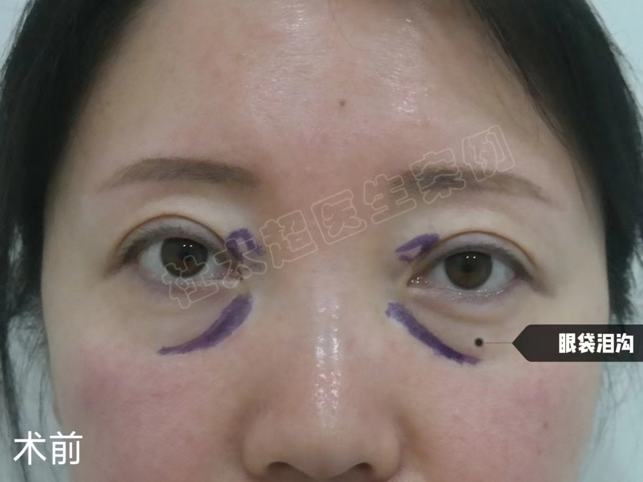 37岁第一次做眼袋手术，感叹手术的神奇，术后7天分享一下