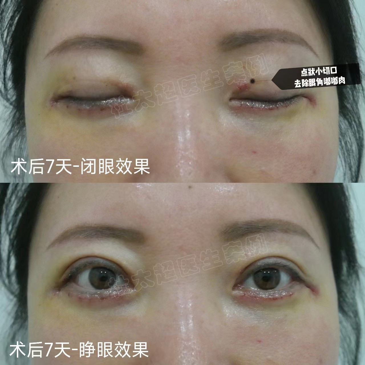 37岁第一次做眼袋手术，感叹手术的神奇，术后7天分享一下