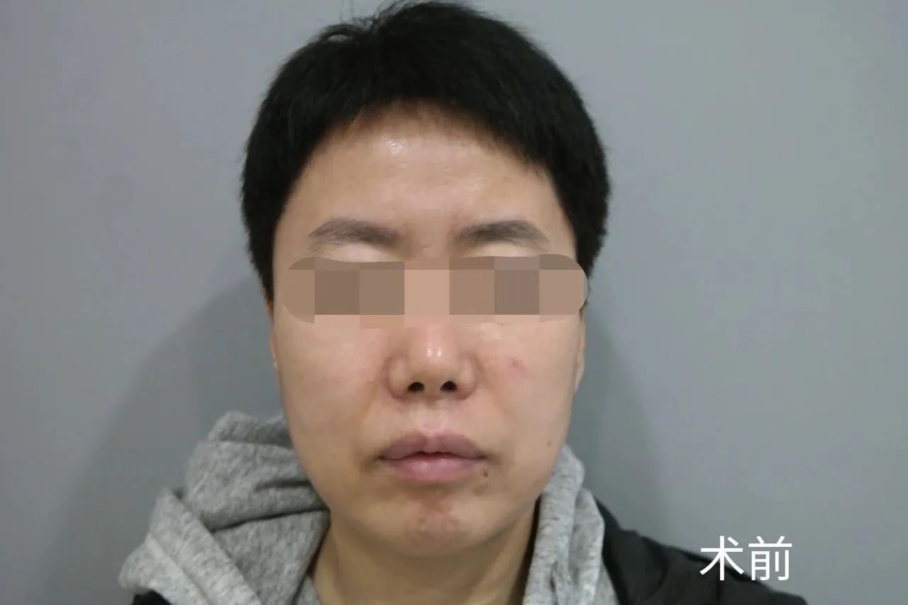 挑战拉皮手术，术后年轻10岁自己都不敢认！