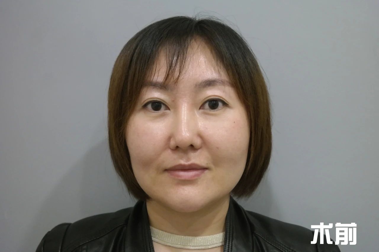 36岁做了拉皮！谈一谈第一次做拉皮手术的感受