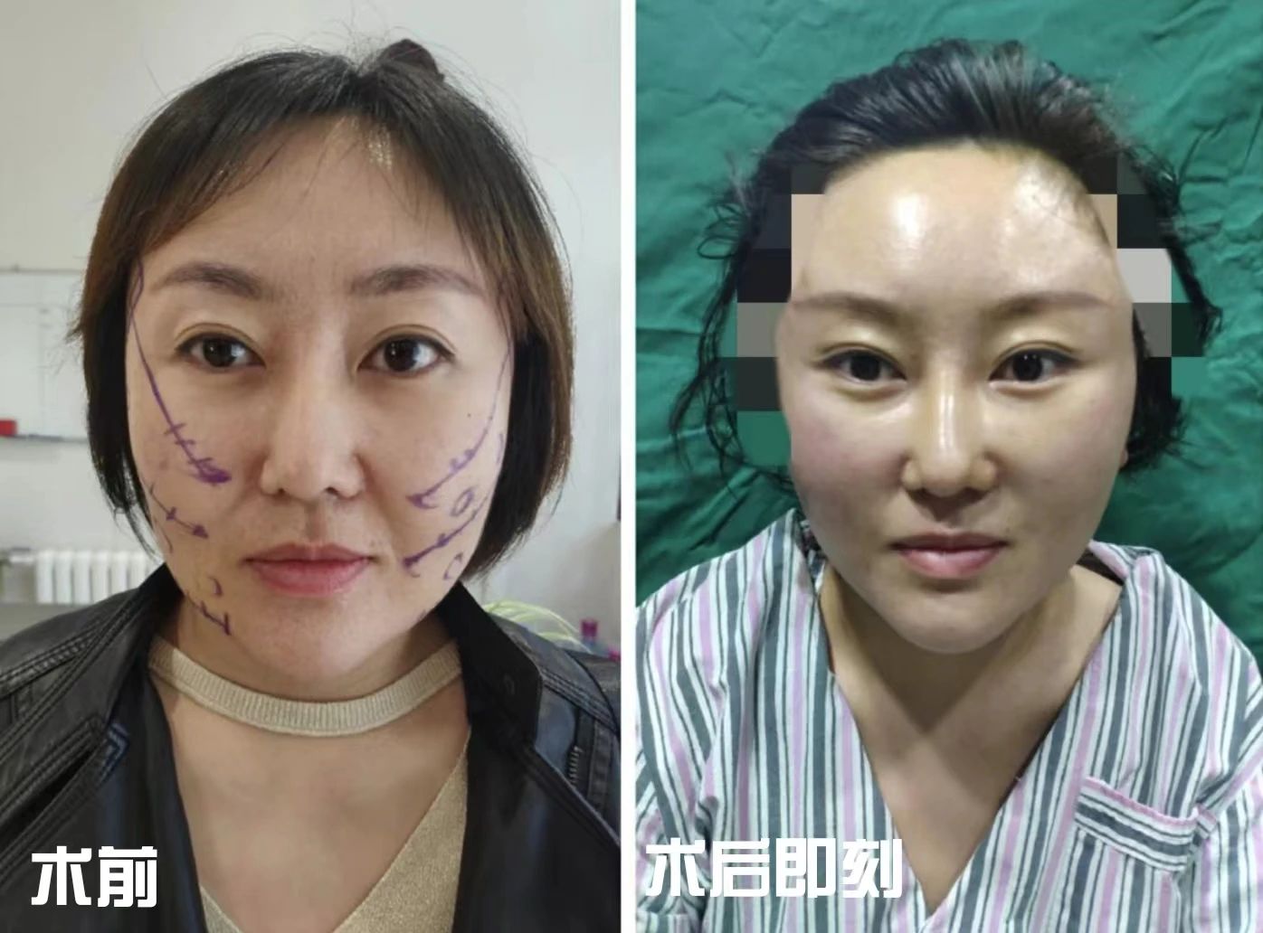 36岁做了拉皮！谈一谈第一次做拉皮手术的感受