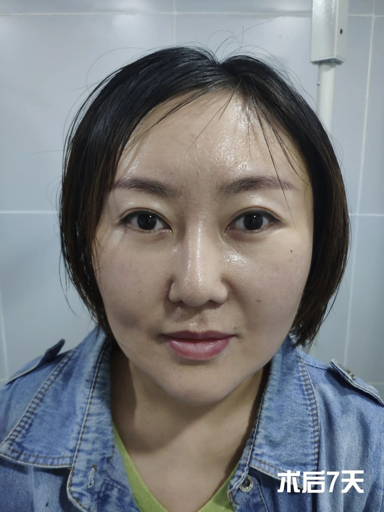 36岁做了拉皮！谈一谈第一次做拉皮手术的感受