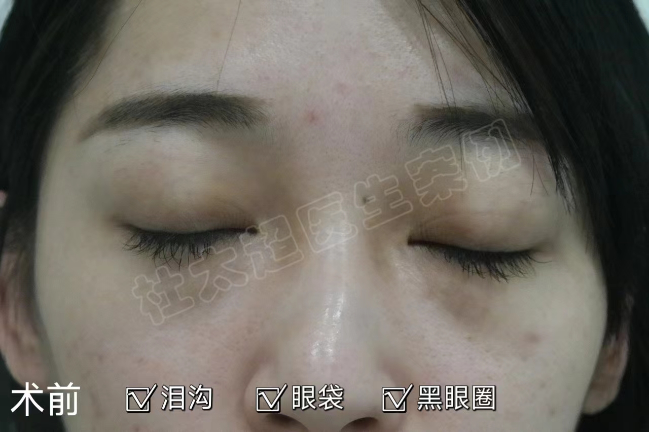 28岁做“眼袋手术”都说早，看完效果都说“好”