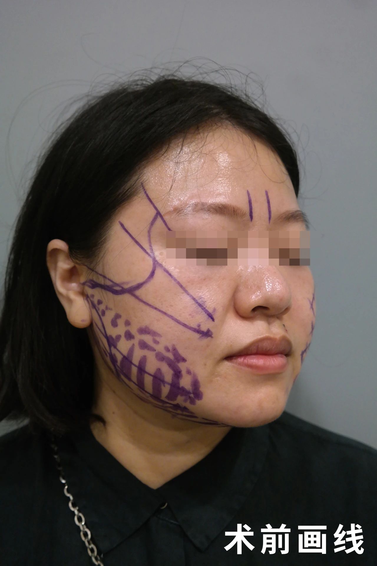 51岁，拉皮手术的神奇效果，变化太大了！