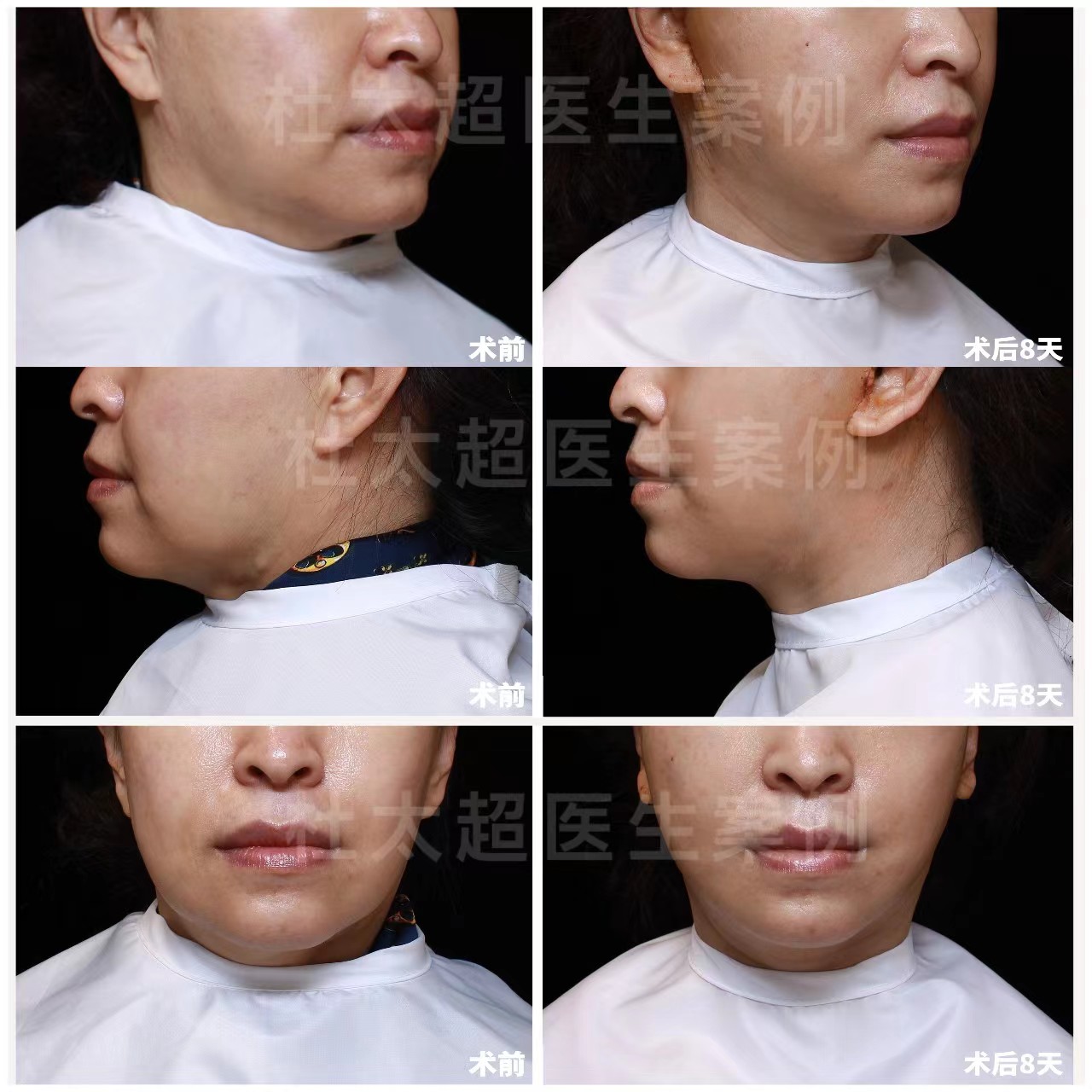 55岁追求年轻，做了拉皮手术，分享术后效果