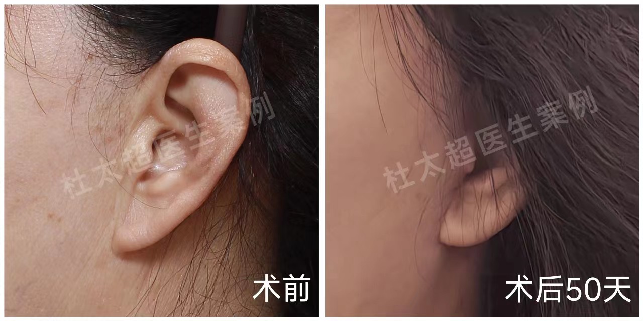 55岁追求年轻，做了拉皮手术，分享术后效果