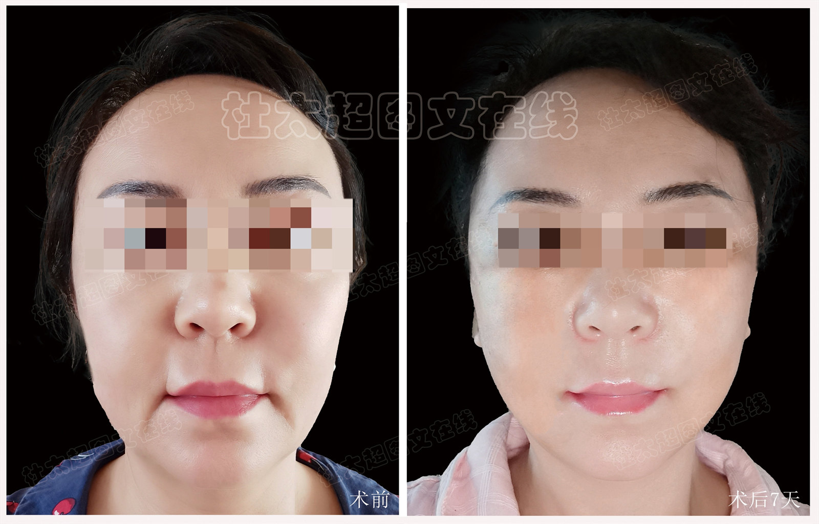 54岁豁出去做大拉皮，公开手术过程