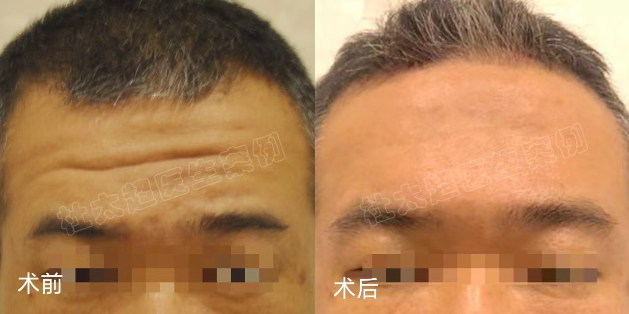 三种额纹去除方法公示，第3种适应症最广