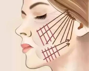 线雕遗留的不可吸收线,需要取出吗? 线雕遗留的不可吸收线,需要取出吗?