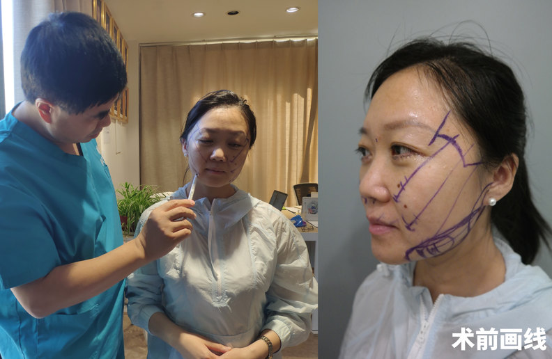 36岁求美者，拉皮手术亲身经历，有效改善法令纹和皮肤松弛问题！