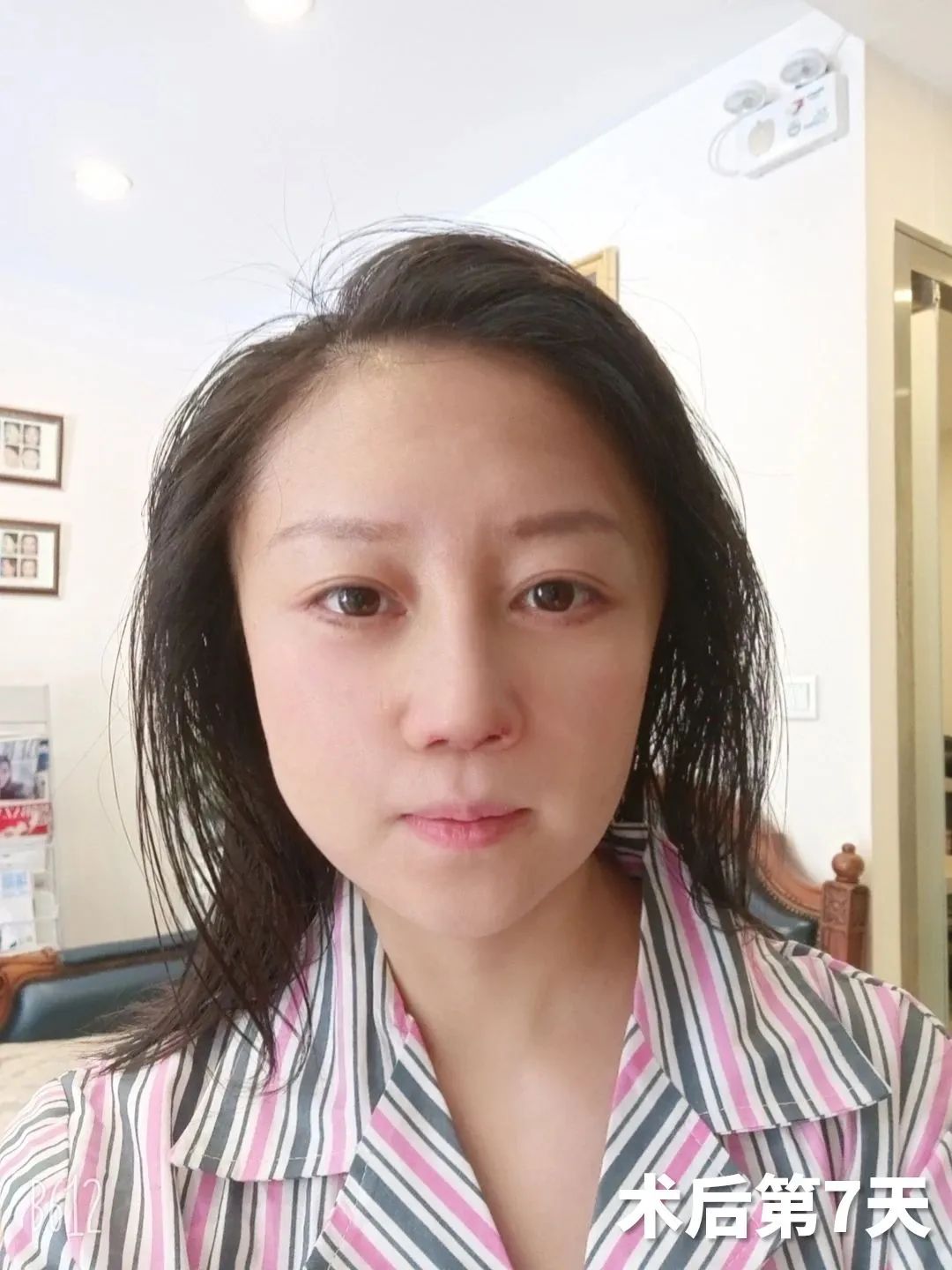 36岁求美者，拉皮手术亲身经历，有效改善法令纹和皮肤松弛问题！