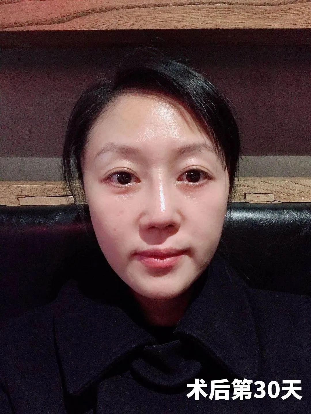 36岁求美者，拉皮手术亲身经历，有效改善法令纹和皮肤松弛问题！