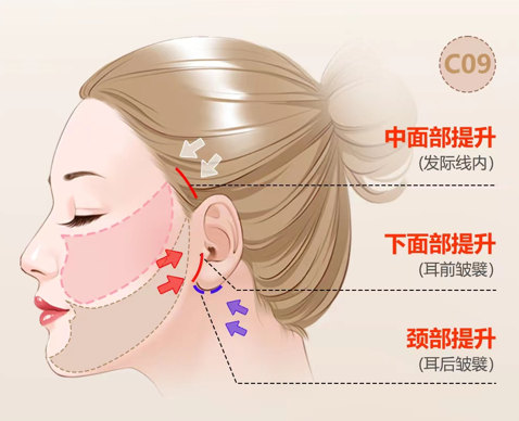 “午间迷你拉皮手术”，你能接受吗？