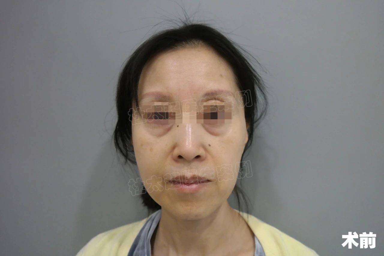 53岁，拉皮手术半年真实记录，脸大变样，效果惊呆了！
