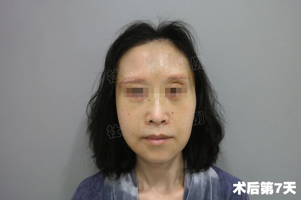 53岁，拉皮手术半年真实记录，脸大变样，效果惊呆了！