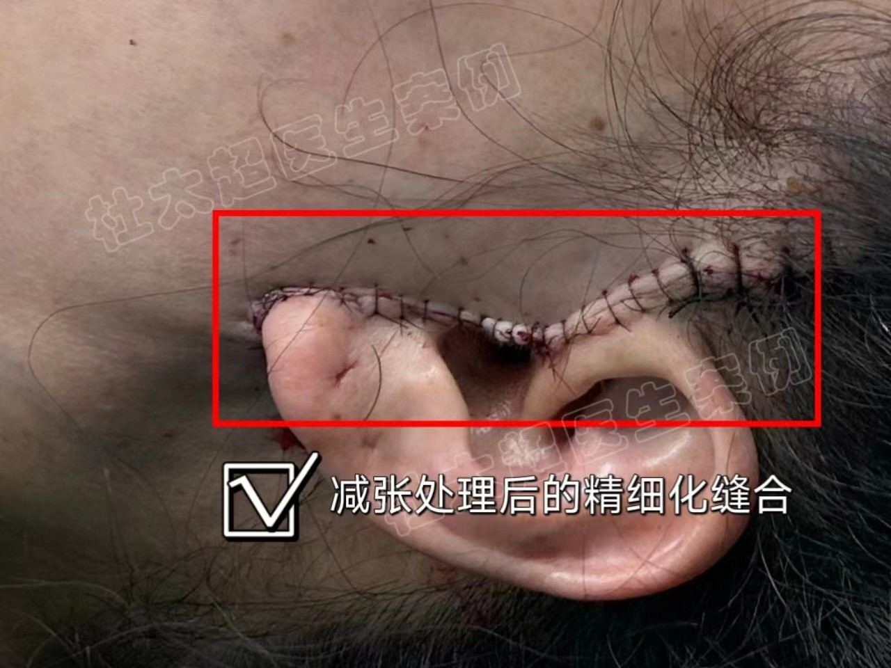 脸部拉皮有没有后遗症？这3点你需要知道