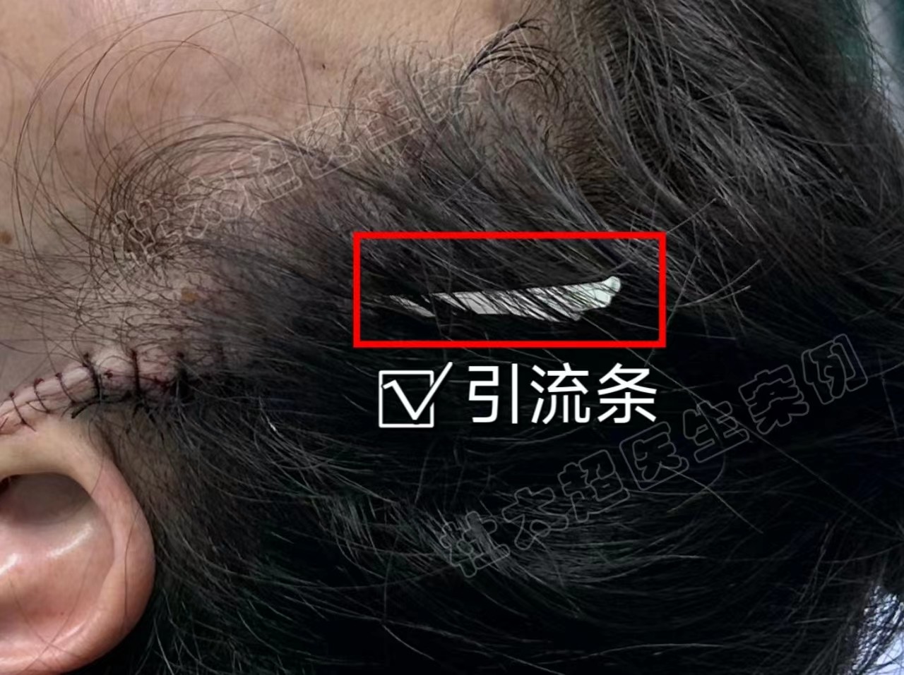 脸部拉皮有没有后遗症？这3点你需要知道